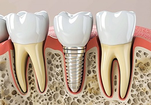 a 3D illustration of a dental implant in the jawbone