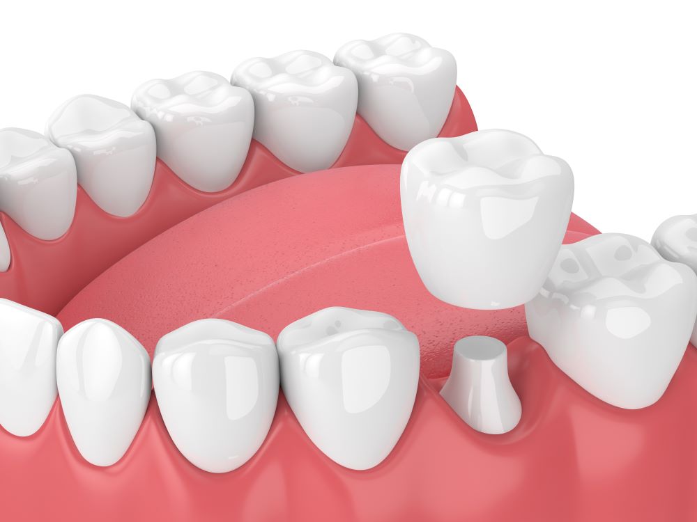 A computer-generated image of a dental crown and how it fits onto a prepared tooth.